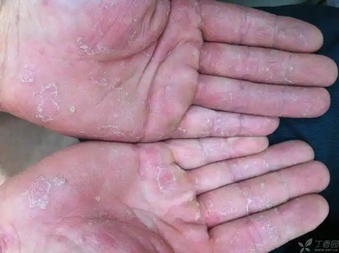 手部银屑病