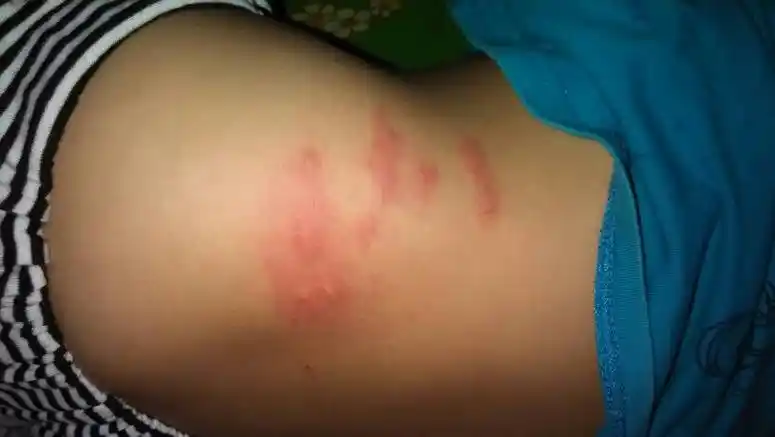 问:我的儿子五岁了,上身长了这个疮,好心的医生麻