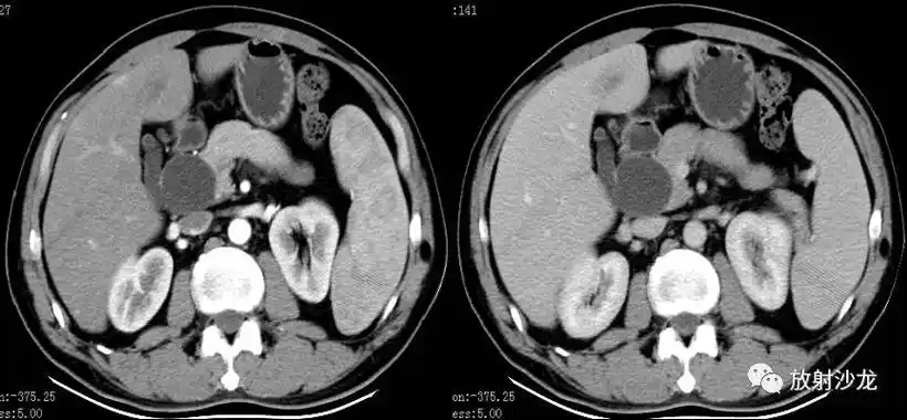 病例解析 | 胆系先天性疾病-medsci.cn