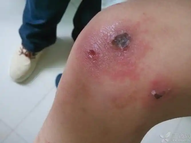 【求助】外伤后皮肤溃疡 [病例帖]