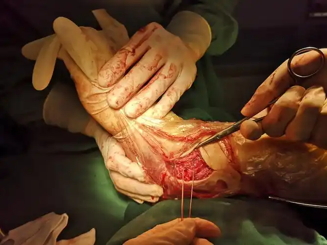 入院诊断:1,右腓骨远端骨折2,右后踝骨折3,右侧三角韧带断裂4,右踝