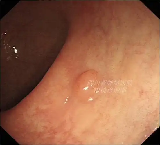 (1)管状腺瘤:是圆形或椭圆形的息肉,表面光滑或有分叶,大小不一,但大