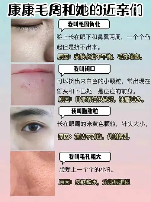 毛周角化与闭口有什么区别