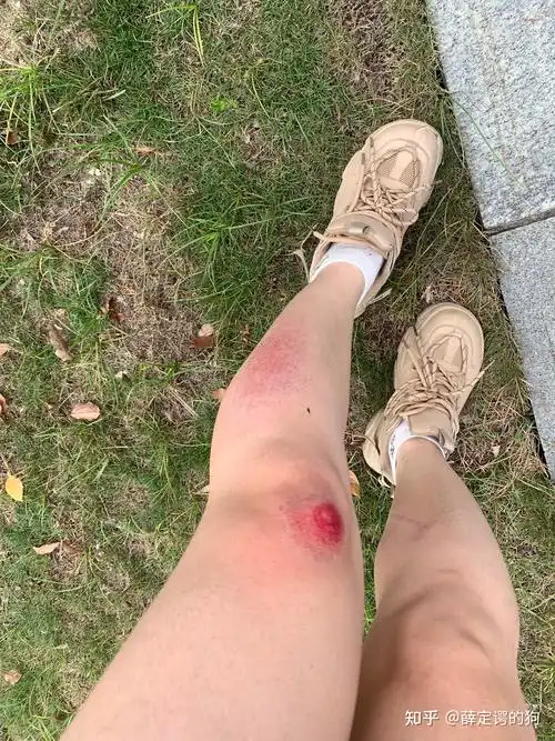 骑车摔倒后擦伤伤口的湿性愈合