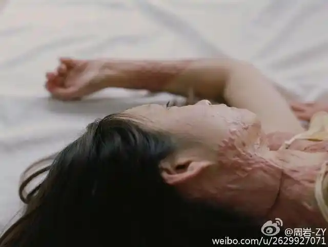 被富二代同学泼汽油烧伤的女孩拍写真 获网友大赞
