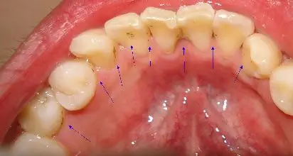 或者说长期的没有爱护牙齿的卫生,有的甚至可能是由于水质的原因引起