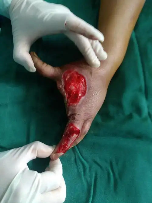 游离尺动脉腕上穿支皮瓣修复手指皮肤缺损_植皮