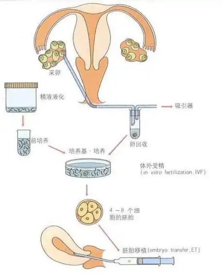 将卵子和精子在体外授精→胚胎体外培养2～6天→胚胎移植 黄体支持(2