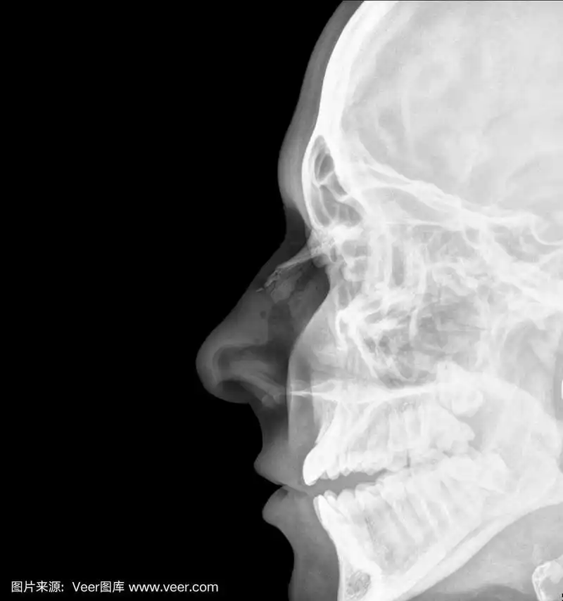 鼻子骨折的x光片