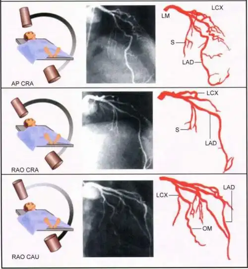 冠脉造影实用读图技巧必备收藏贴