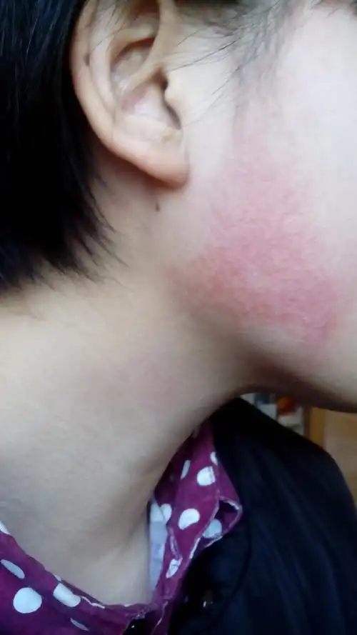 不过不疼也不痒,看网上说是毛周角化症.