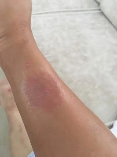 一片密集的小水泡是跳瘙咬的吗?