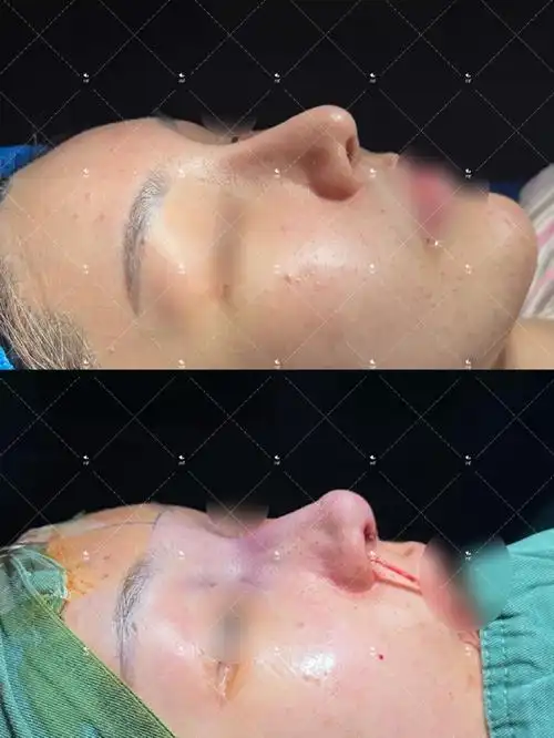 肋软骨 膨体隆鼻术后,这次是第三次做肋软骨鼻了