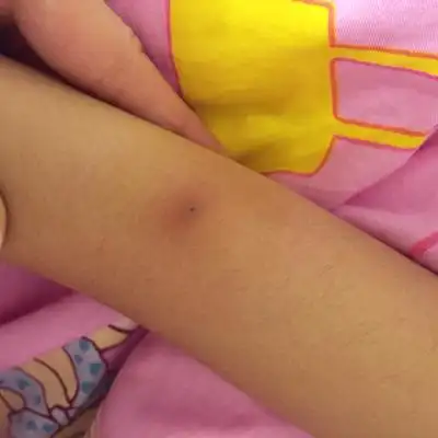 女儿胳膊上突然长个这麼个东西,裏面有核,硬硬的,说有点很疼 挤不出来