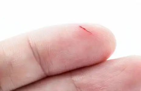 手指伤口图片
