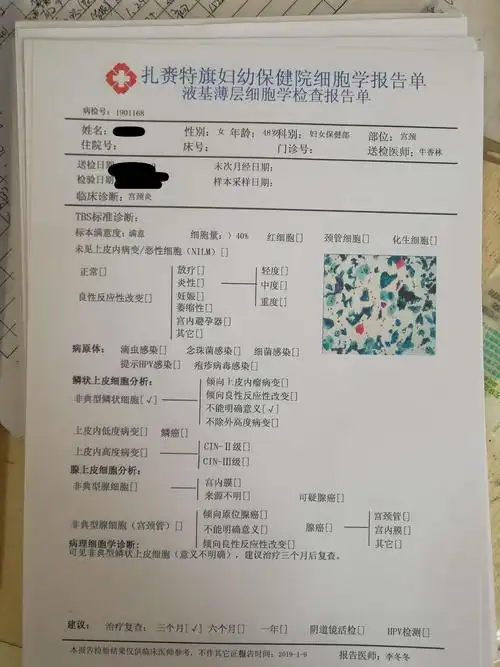 宫颈癌筛查是怎么回事儿