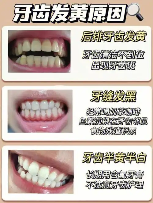 牙黄牙渍退退退!黄牙休想沾边7215