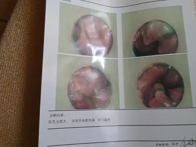 图片是我肛肠镜检查报告目前只感觉有点肿胀医生说必须手术