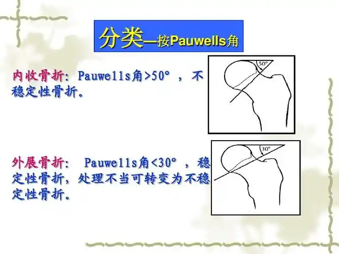 股骨颈骨折的护理新ppt