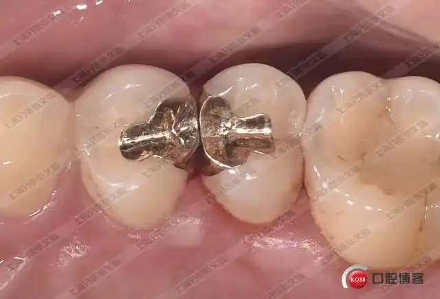 我就在那默默的做着我的金嵌体