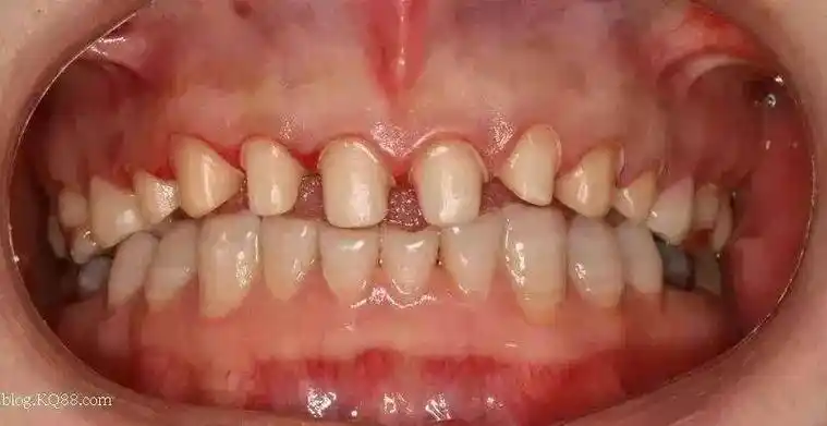 冷光美白烤瓷牙美白和贴面美白该怎么选