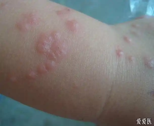 螨虫皮炎治疗前后,您来看一看 - 皮肤及性传播疾病讨论版 - 爱爱医