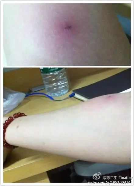 手臂上长了一个硬包,一碰就疼还肿了一大片,请问怎么简单的处理一下