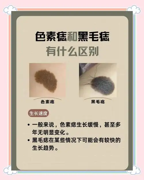 面部痣特征:色素痣与黑毛痣大不同