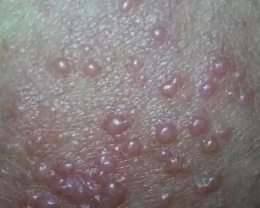 女性阴囊湿疹症状图片_有来医生