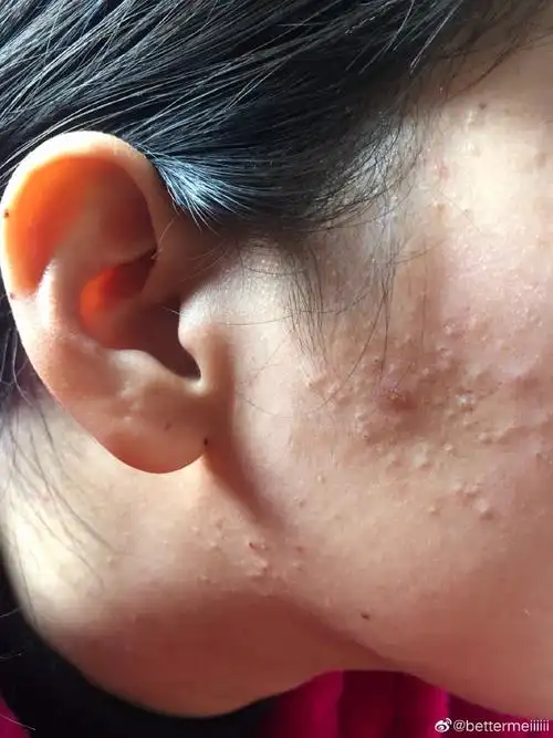 女生脸上长闭合型粉刺怎么治疗