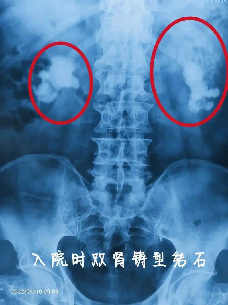 男性患者,体检发现双肾结石1年,左肾铸型结石:6.0×5.9 - 抖音