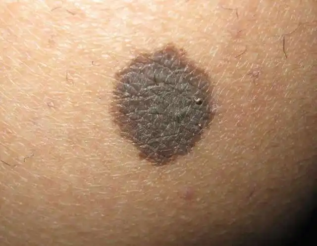 如果"黑痣"长在这3个部位,多留意|黑斑|肿瘤_网易订阅