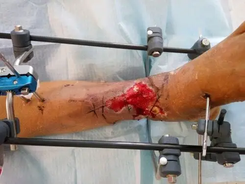 清创外固定架 vsd负压吸引技术治疗一例开放骨折后踝