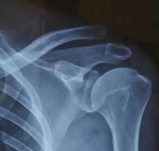 司法鉴定科学研究院对肩锁关节脱位人体损伤程度的法医临床鉴定案