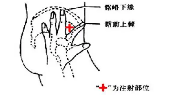 髂前上棘体表定位图 (第1页)