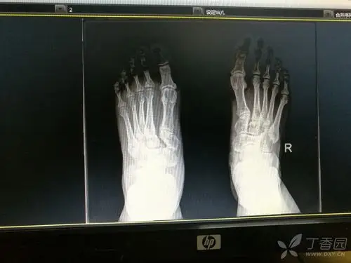 一例楔骨骨折伴脱位,请指导治疗 [病例帖]