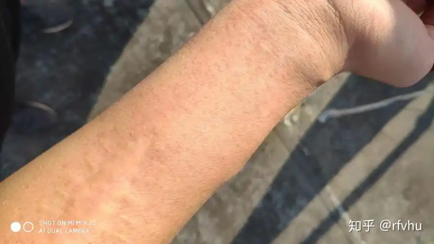 胆碱能性荨麻疹就这样好了,部分病友可以试试