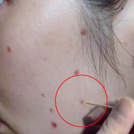 美容金水去黑痣膏点凸痣药无痕正品祛痣灵痦子苍蝇屎取痣脱痣除志