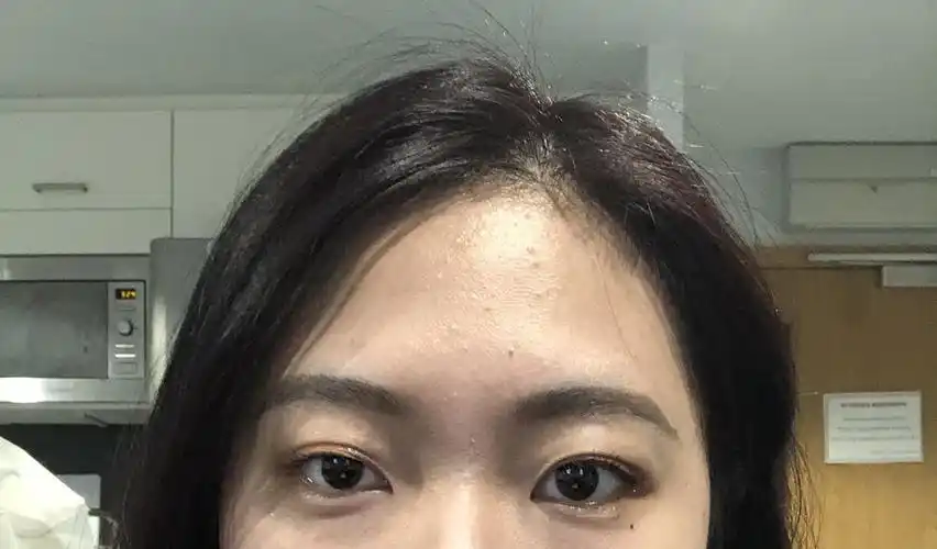 求问我这种大小眼可以矫正吗,后置简直死亡