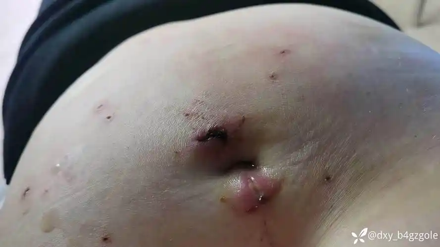 腹腔镜术后伤口愈合不良