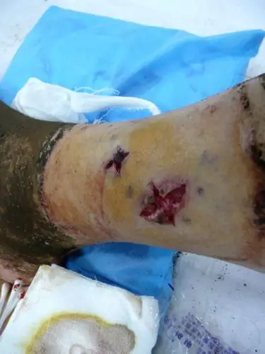 刚被这东西咬了一口现在不知道该怎么办了