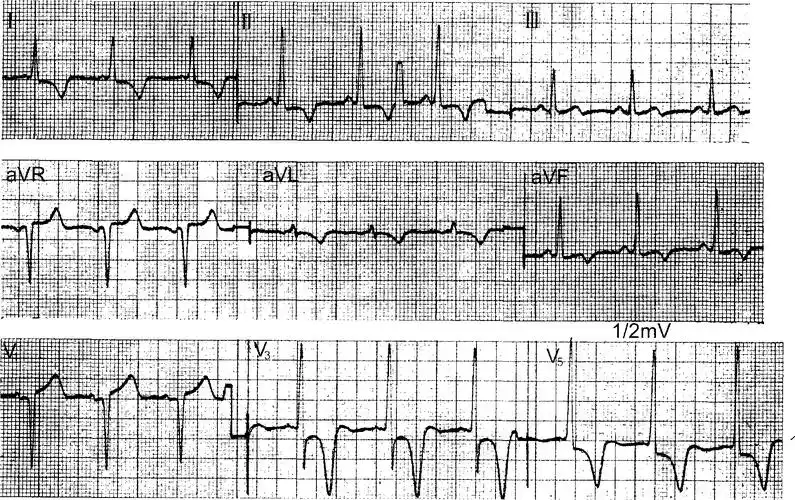 二,左心室肥大(图1-19～1-30)-心血管-医学