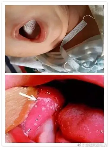 马牙和鹅口疮傻傻分不清教你学会辨别并做到科学护理