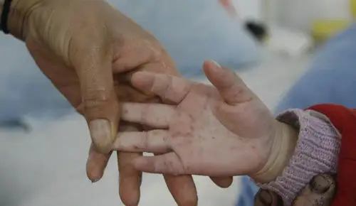 云南手足口病进入高发期 目前尚无预防疫苗