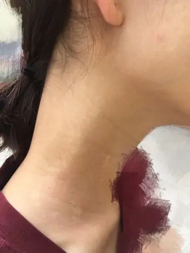 脖子上有一片肤色泛白,我想知道是白癜风么?