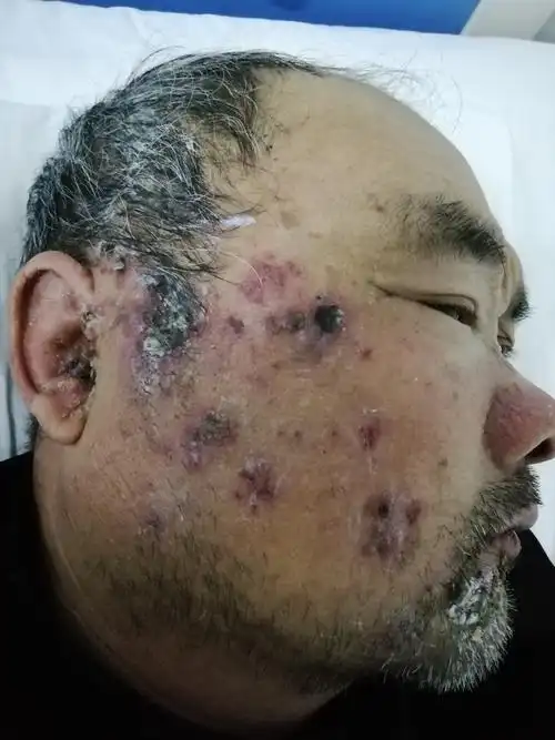 又名膝状神经节炎由水痘- 带状疱疹病毒侵犯第8颅神经节和面神经的膝