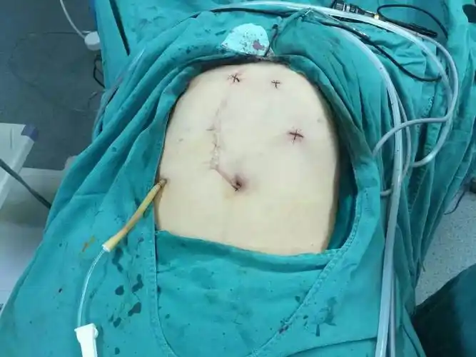 关于有上腹部手术史的病人是否可以接受腹腔镜微创手术?可以