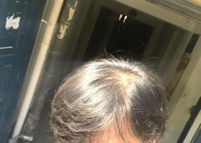 30岁地中海秃女生是不是不得行了