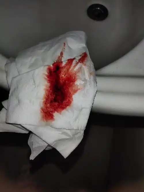 [试管婴儿]移植第十天出血了,怎么办?抽血