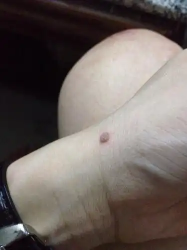 手上不知什么时候长了颗肉粒,不痛不痒,表面粗糙的,这是什么啊